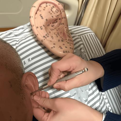 舌强不语的针灸部位