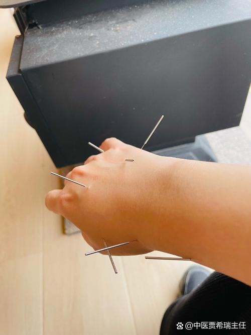 慢性咽喉炎能针灸吗