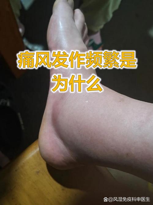 痛风一般多久复发一次