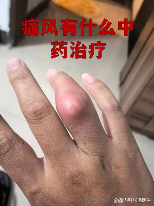 治疗痛风最好的土方法