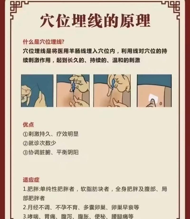 针灸埋线减肥示意图