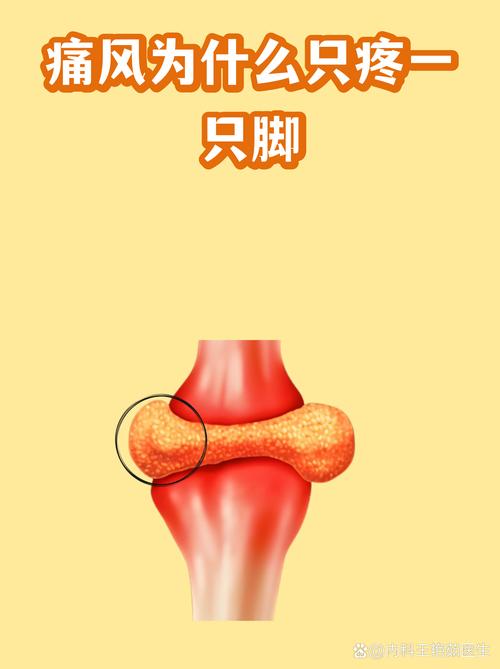 为什么痛风就痛一只脚