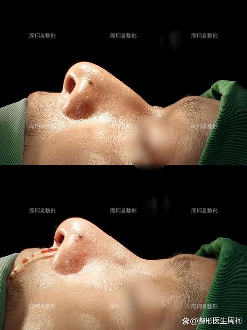 做歪鼻整形安全不安全