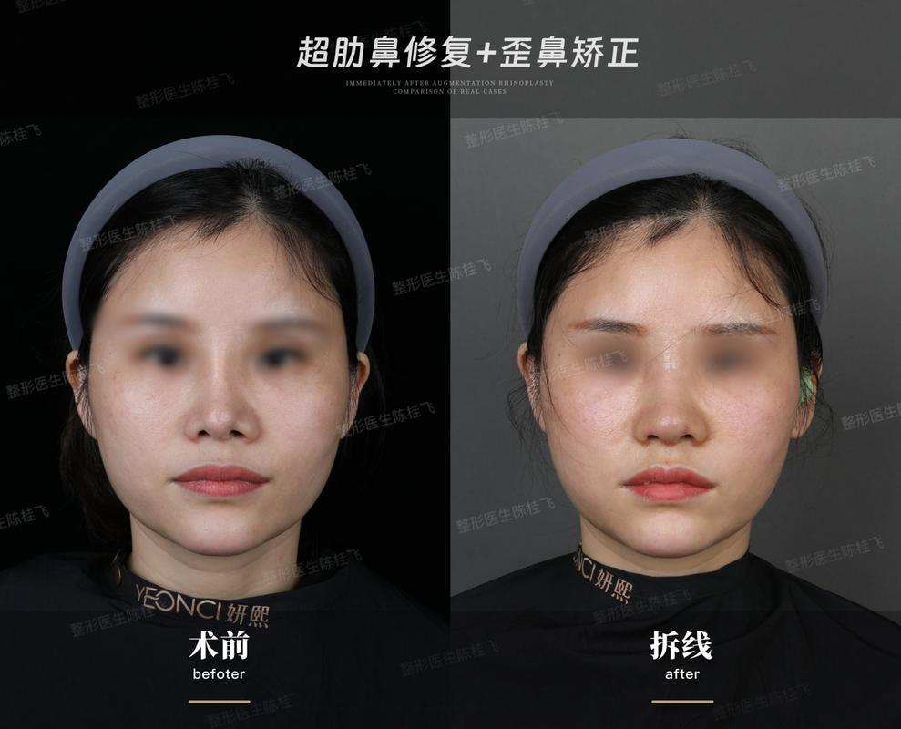 做歪鼻整形安全不安全