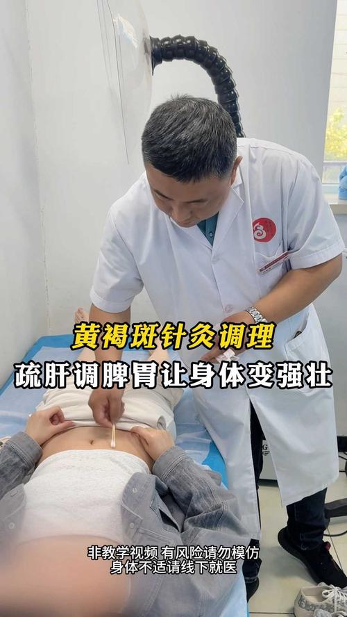 针灸可以治黄褐斑吗