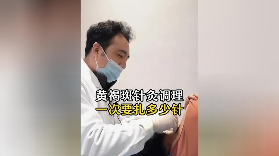 针灸可以治黄褐斑吗