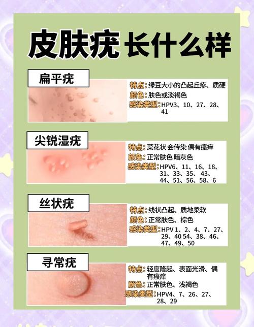 针灸治扁平疣有效吗