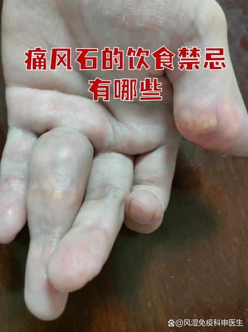 痛风石和痛风一样吗