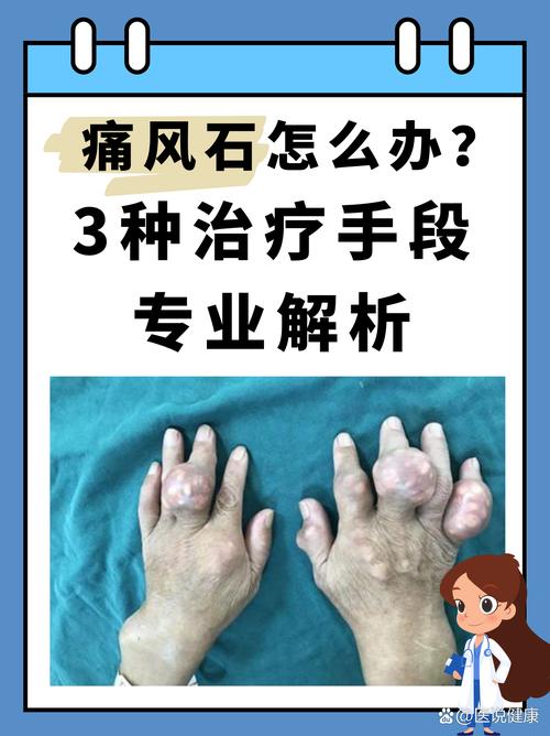 痛风石和痛风一样吗