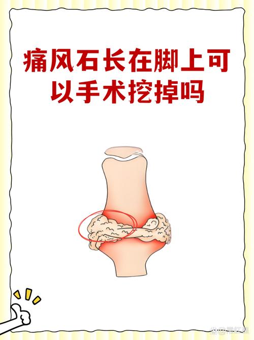 痛风结晶是痛风石吗