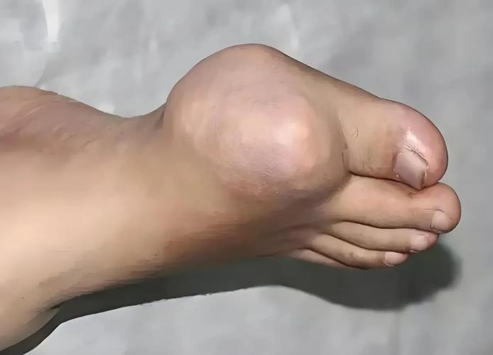 痛风初期有痛风石吗