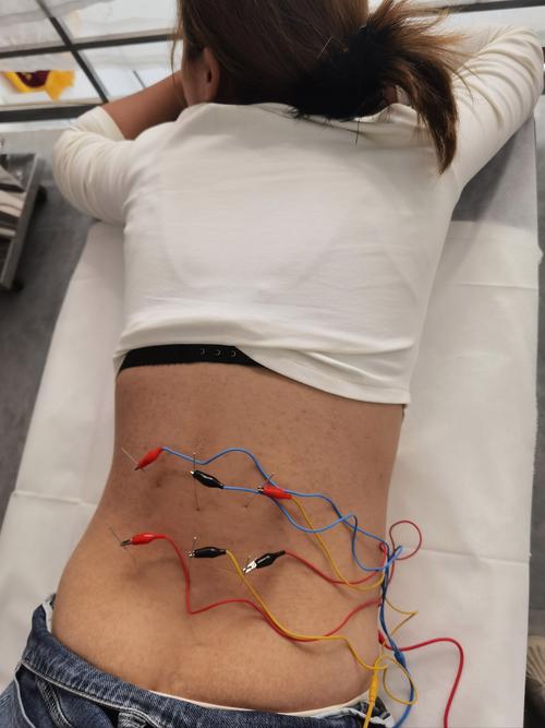 腰椎间盘突出用针灸