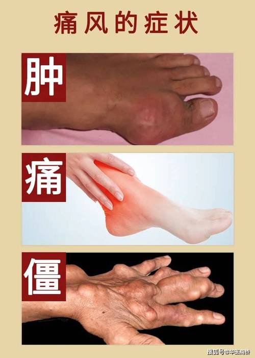 痛风一般痛一个脚吗