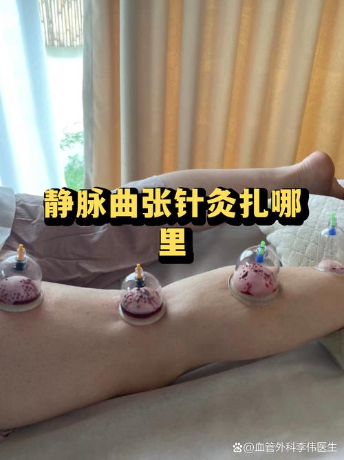 静脉曲张针灸能治吗