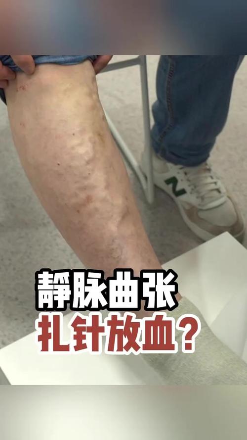 静脉曲张针灸能治吗