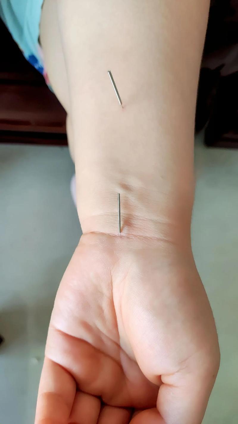 腕管综合征怎么针灸