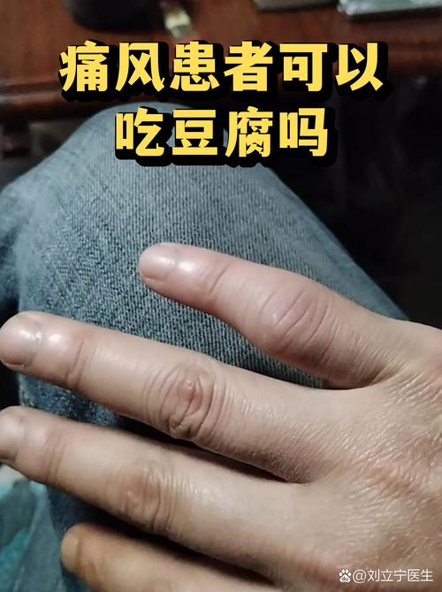 痛风能不能吃豆腐干