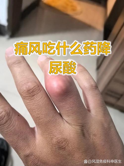 痛风能吃碳酸氢钠吗