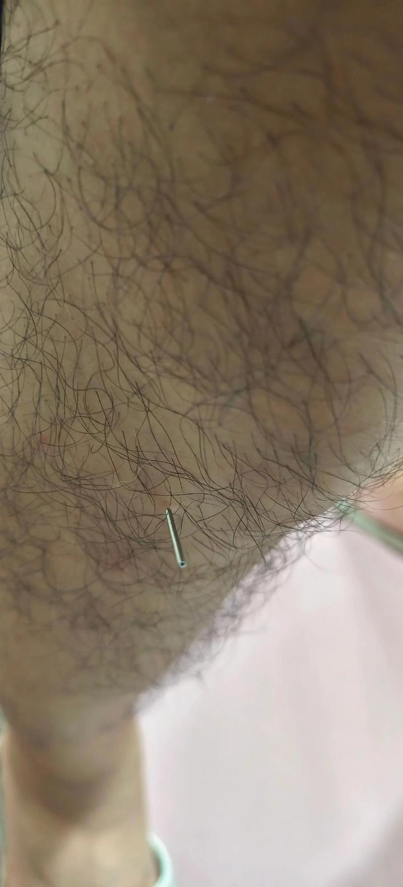 倪海厦人纪针灸18