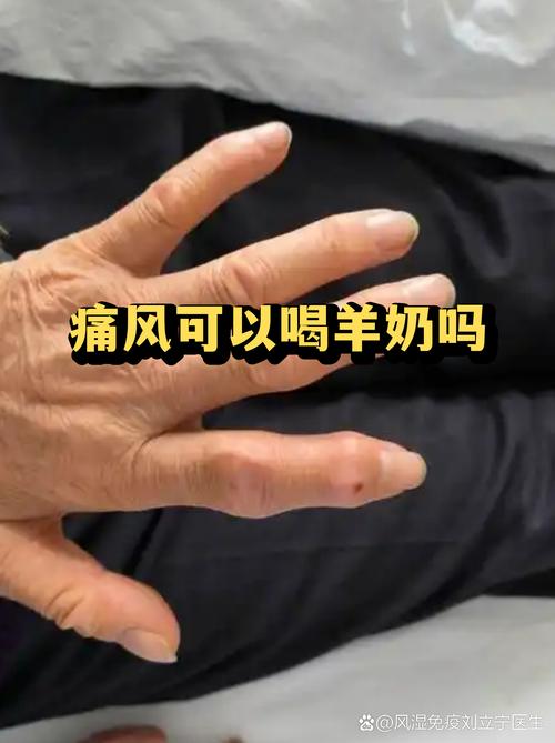 痛风能喝百事可乐吗