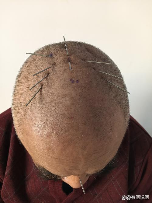 针灸能治神经受损吗