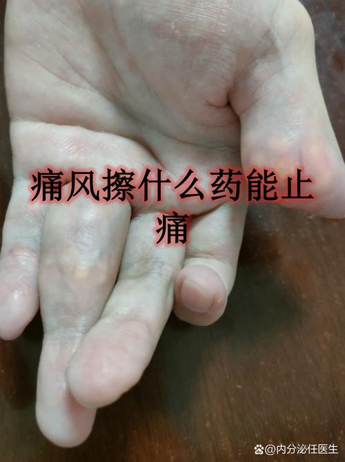 痛风能不能喝胡辣汤