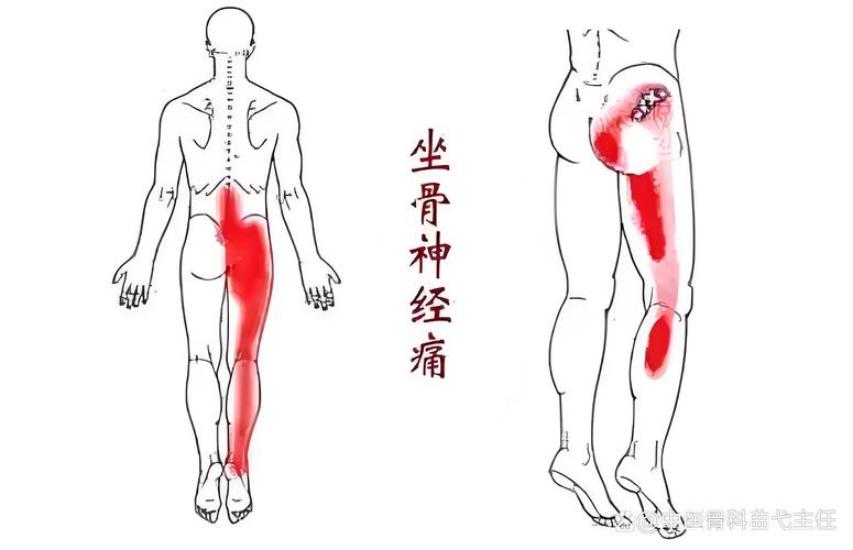 痛风引起坐骨神经痛