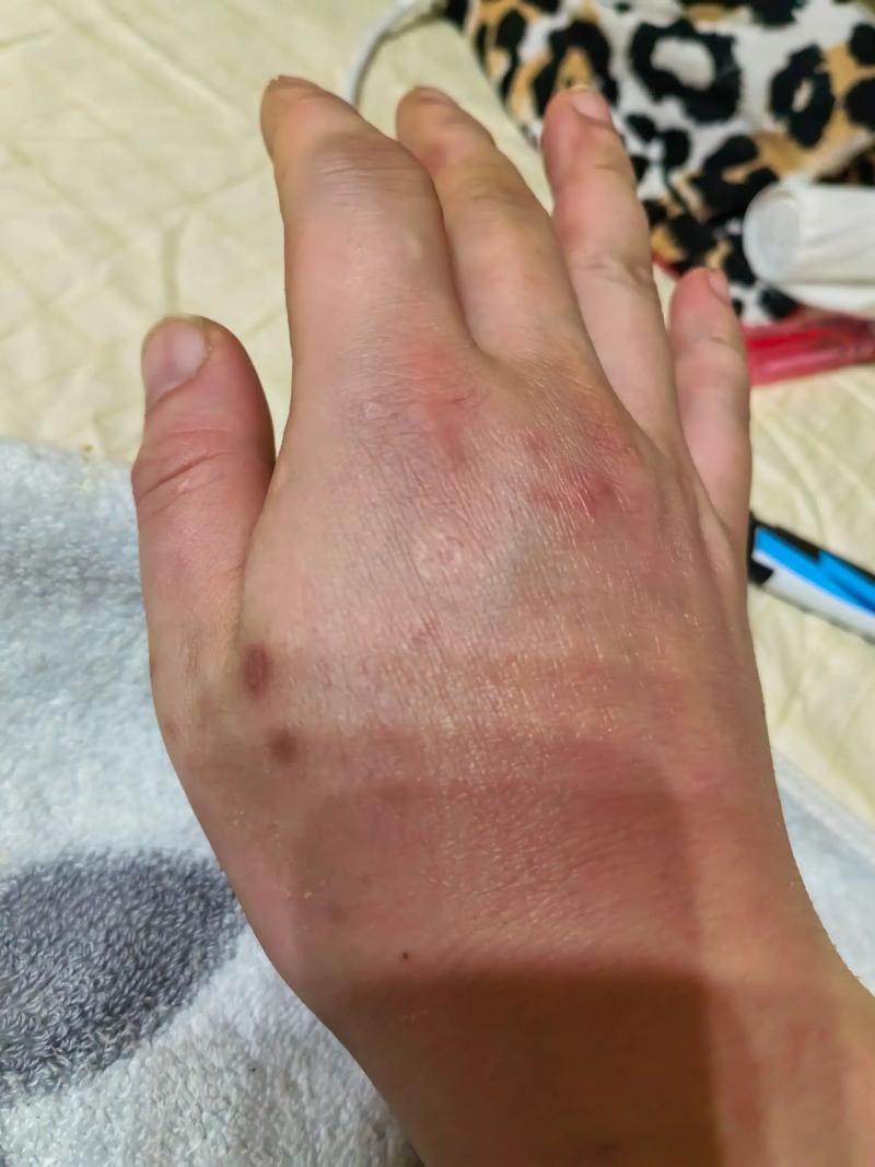 痛风发手上 三个月