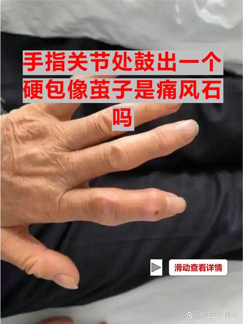 痛风发手上 三个月