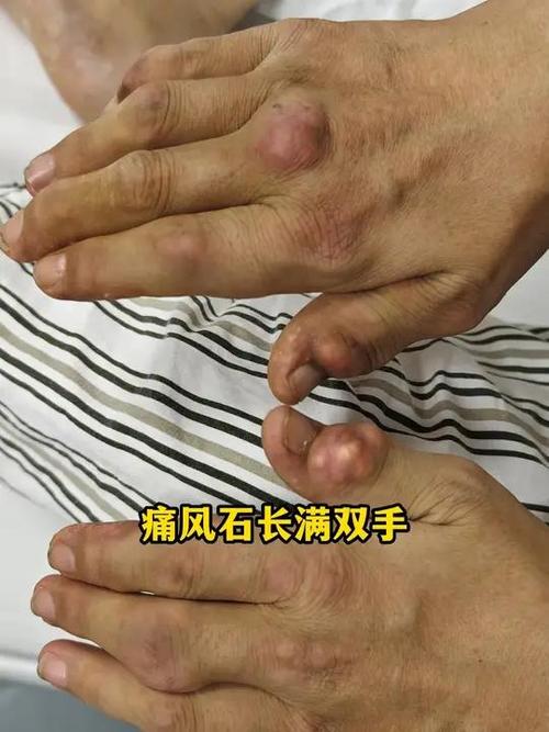痛风发手上 三个月