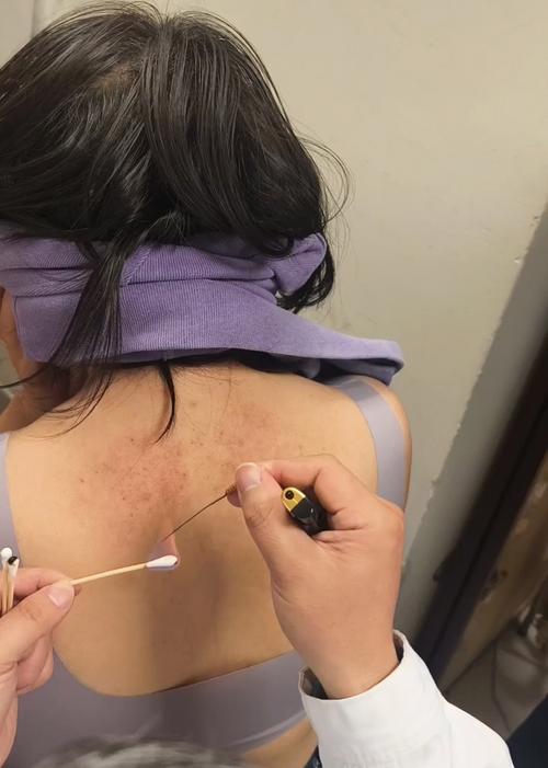 针灸刺血疗法怎么样