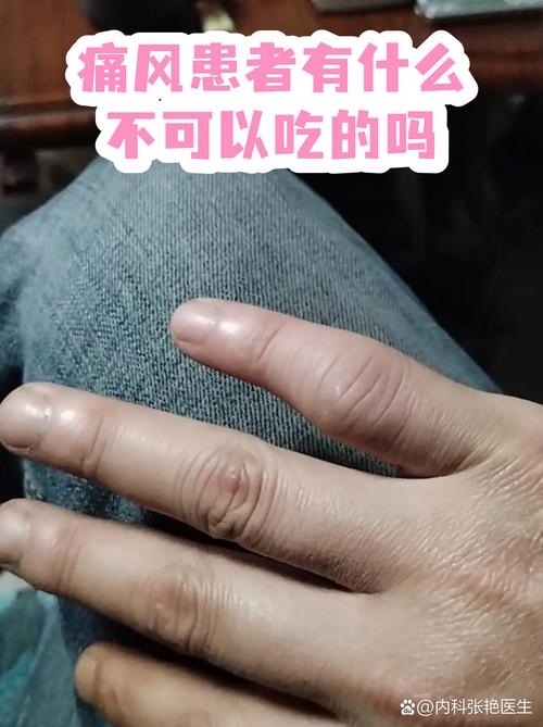 痛风可不可以吃鸭舌