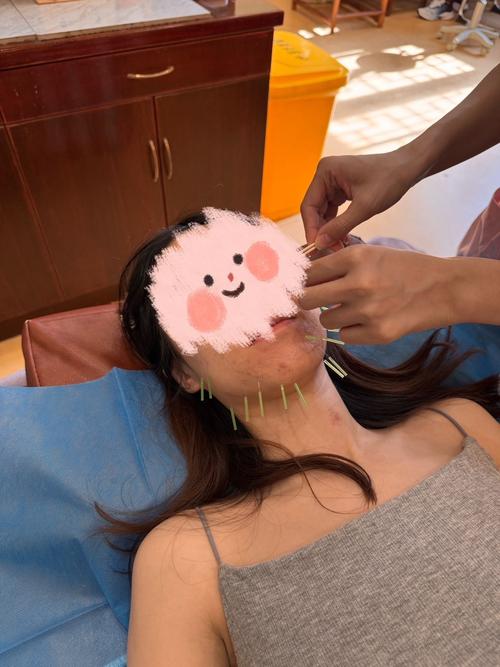 长春市针灸祛痘医院