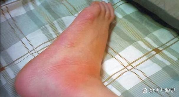 痛风几十年没发作过