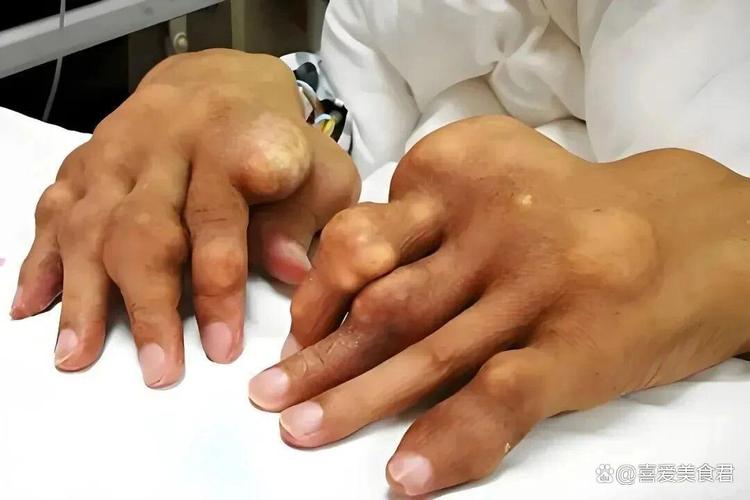 痛风几十年没发作过