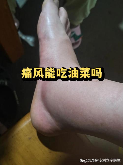痛风与脑梗有无关系