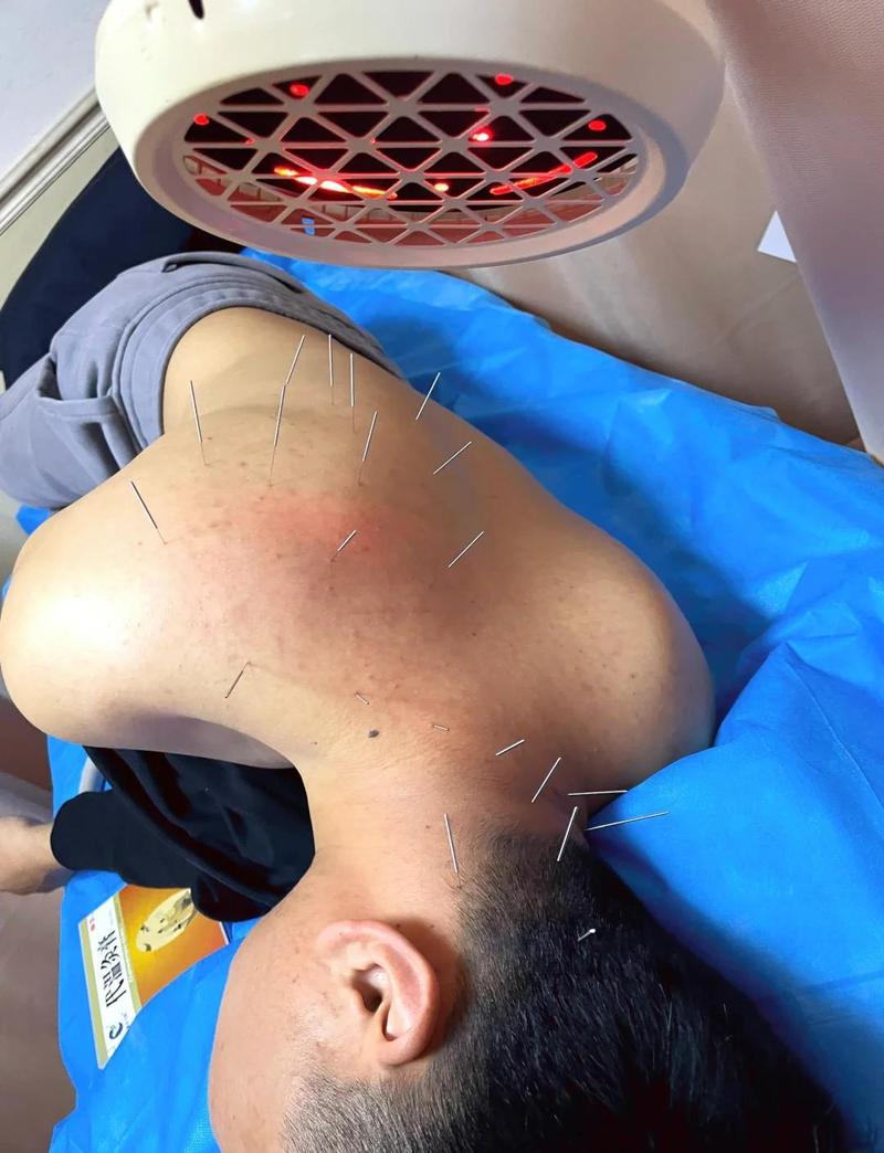 亚急性甲状腺炎针灸