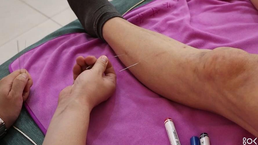 亚急性甲状腺炎针灸