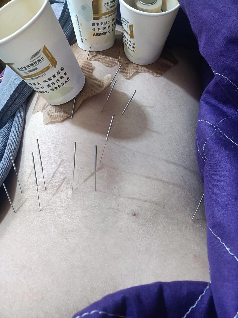 中国最厉害的针灸师