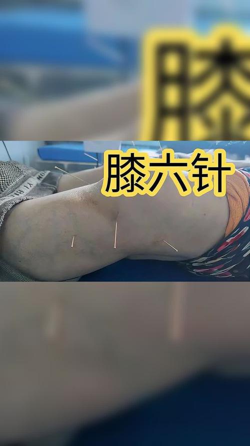 膝关节疼痛能针灸吗