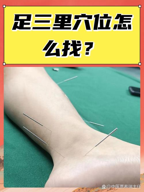 针灸多囊卵巢综合征