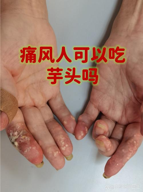 痛风可以吃地三鲜吗