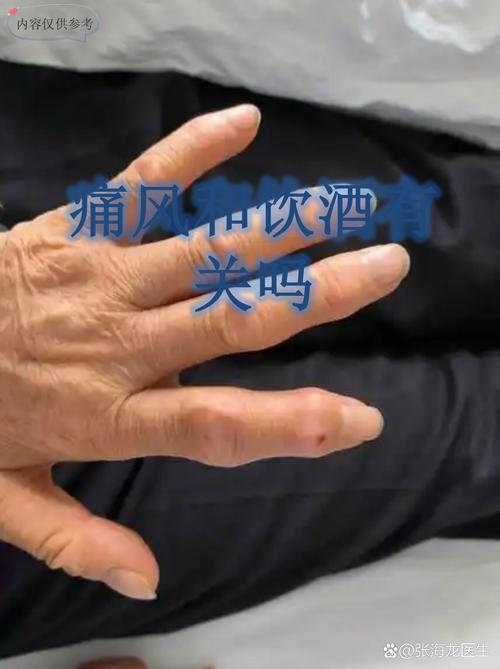 痛风喝康宝莱可以吗