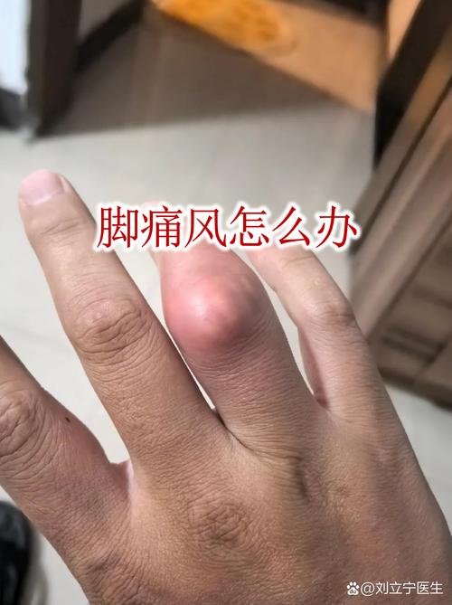 几十年痛风怎么处理