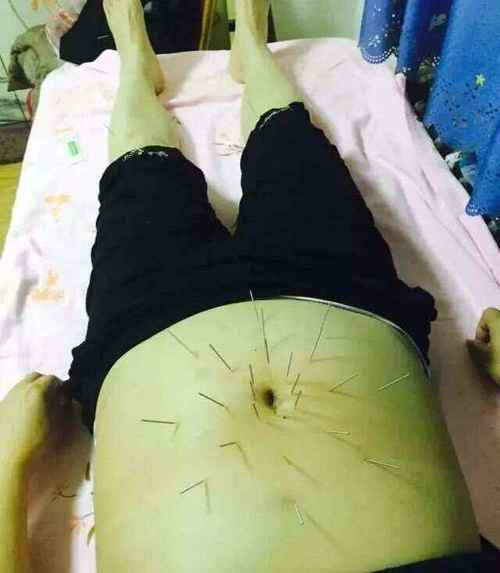 济南中医院针灸减肥