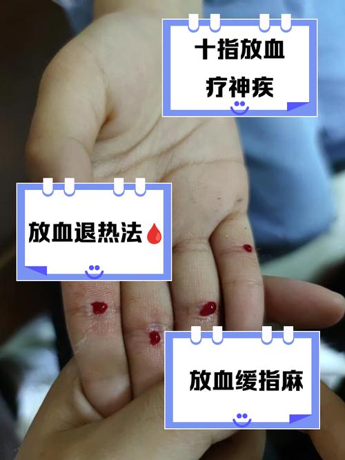 肝郁针灸放血有用吗