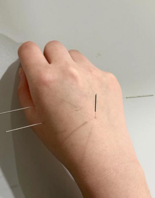 人流后能不能做针灸