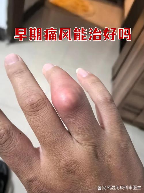 北京治痛风国康一流