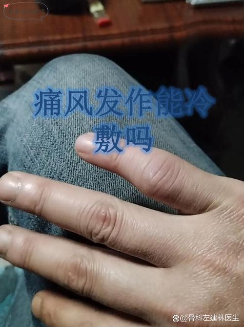 北京治痛风国康一流