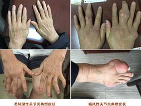痛风性关节炎和风湿